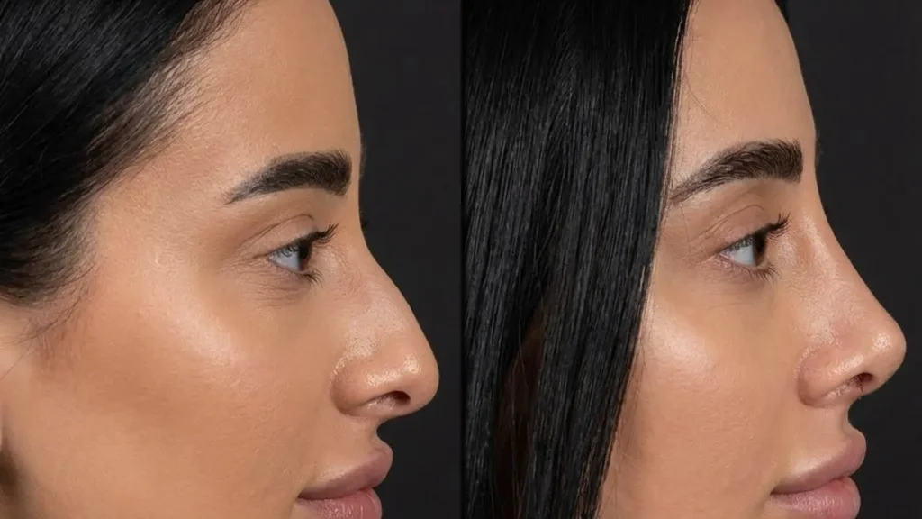 Was ist eine Piezo-Rhinoplastik? Vorteile, Genesungsprozess und häufig gestellte Fragen
