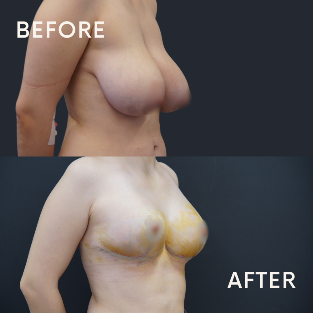 breast-reduction-before-after-4