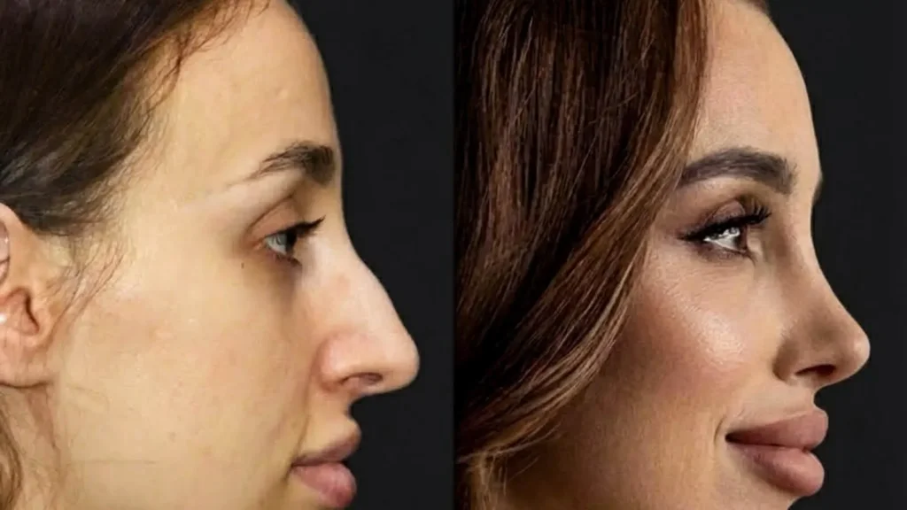 rhinoplasty before and after 