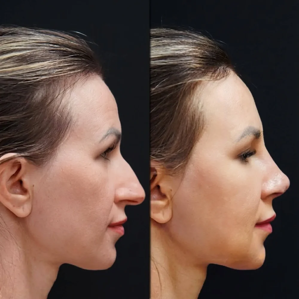 Burun Ameliyatı Fiyat Rehberi 2025: Türkiye vs ABD/İngiltere Karşılaştırması