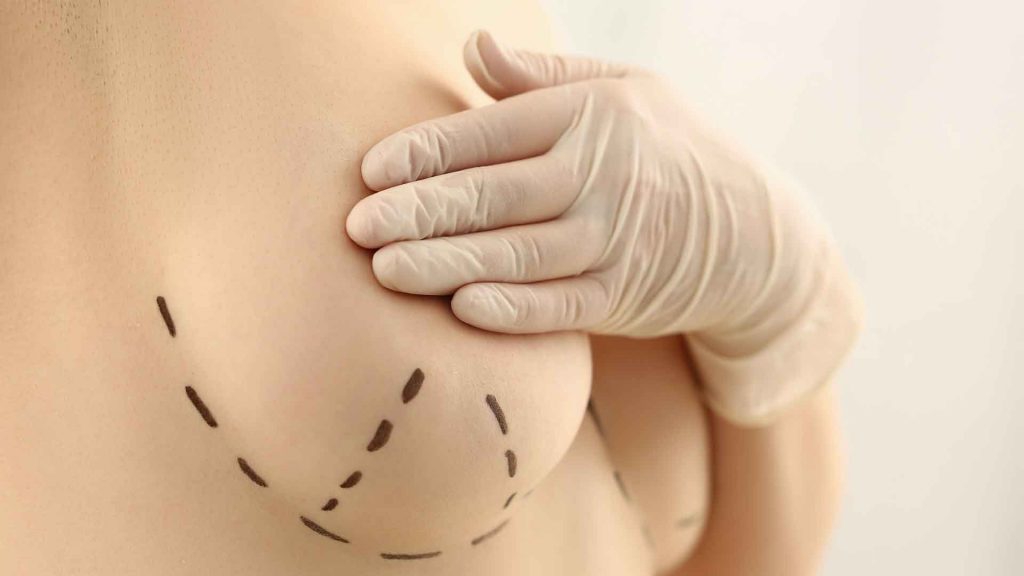 5 Common Misconceptions About Breast Implants