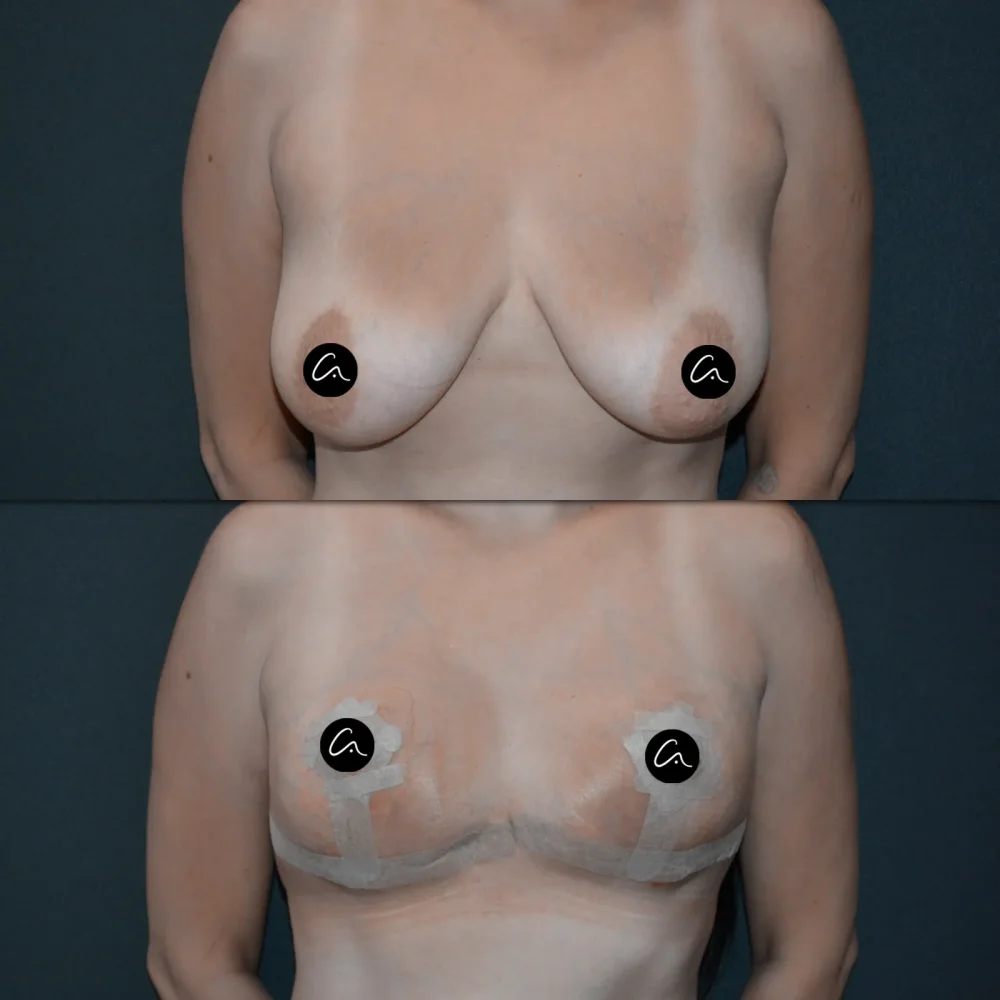 breastlift7.webp