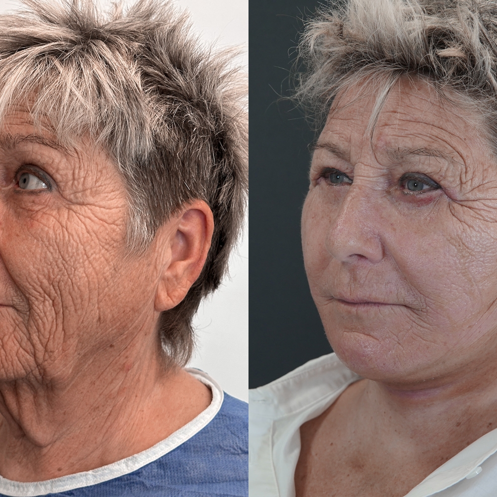 ¿Quién realiza mejor la rinoplastia?