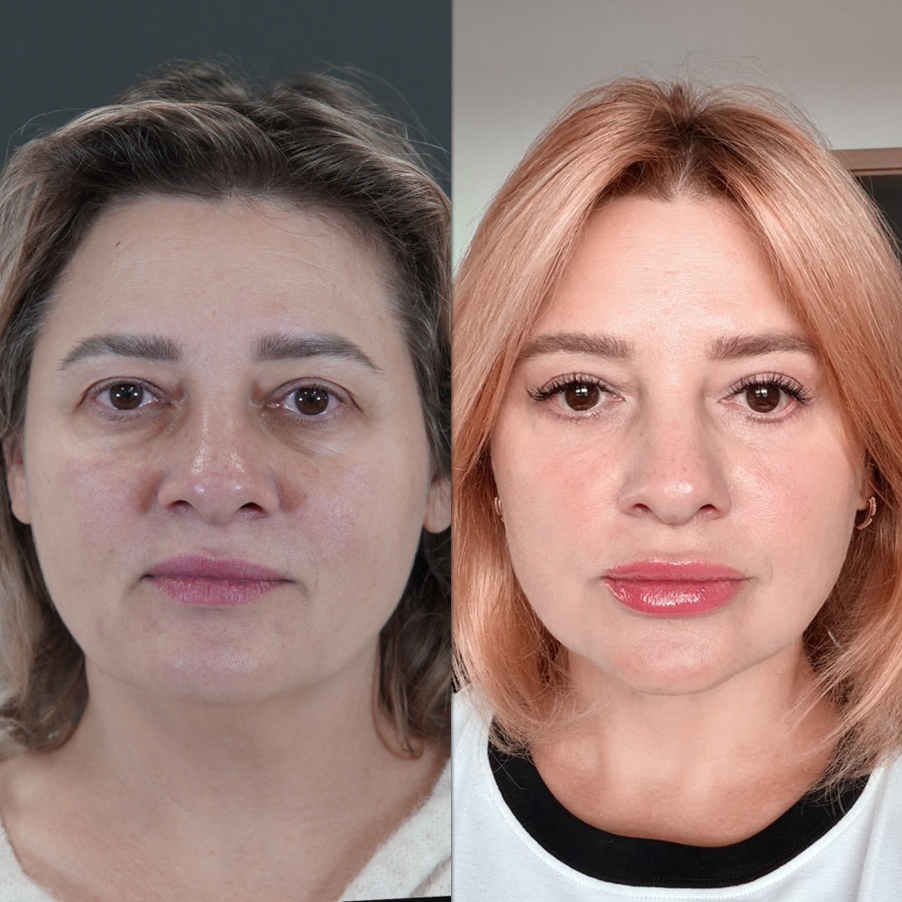 ¿Quién realiza mejor la rinoplastia?