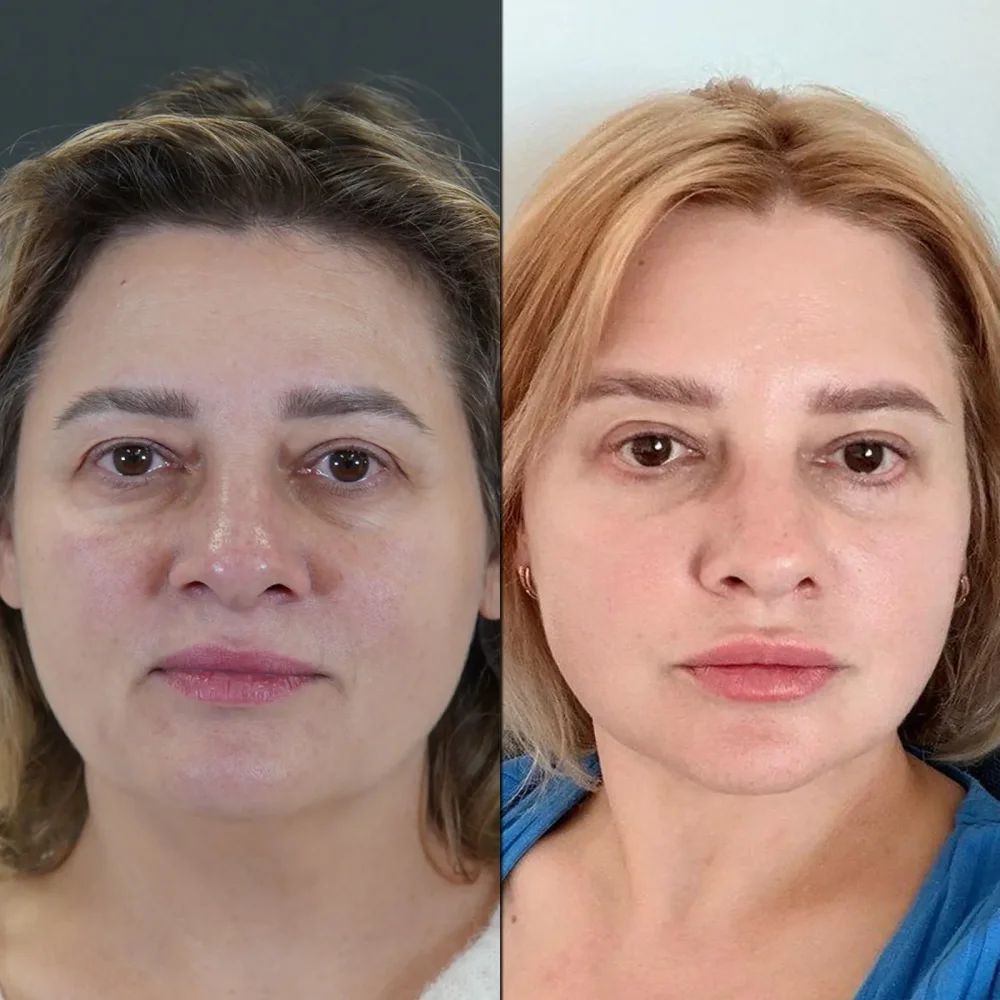 Who Performs Rhinoplasty Best?
