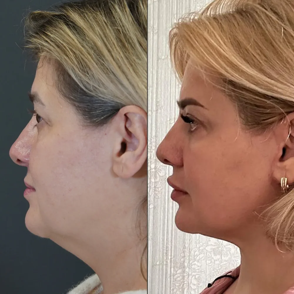 ¿Quién realiza mejor la rinoplastia?