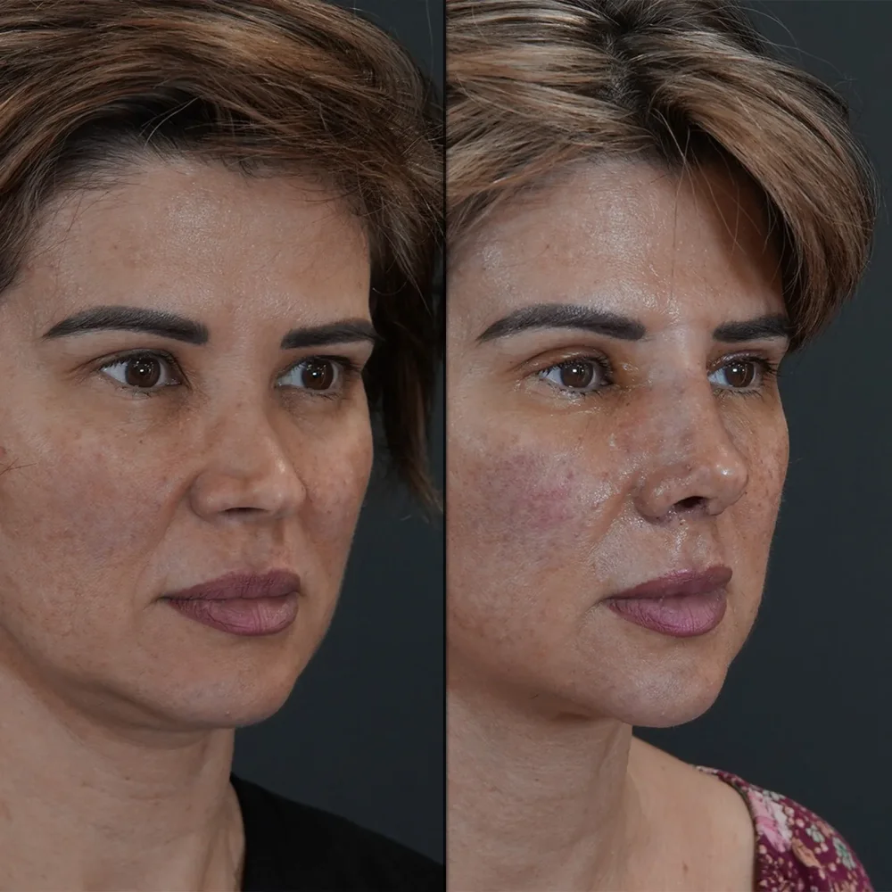 Цены на пластическую хирургию в Турции 2025 | Подробное руководство для иностранных пациентов