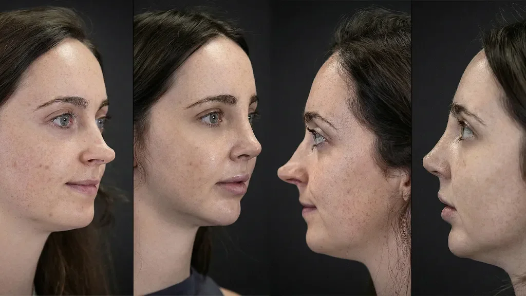 Bester Revisions-Nasenchirurg Türkei | Dr. Celal Alioglu