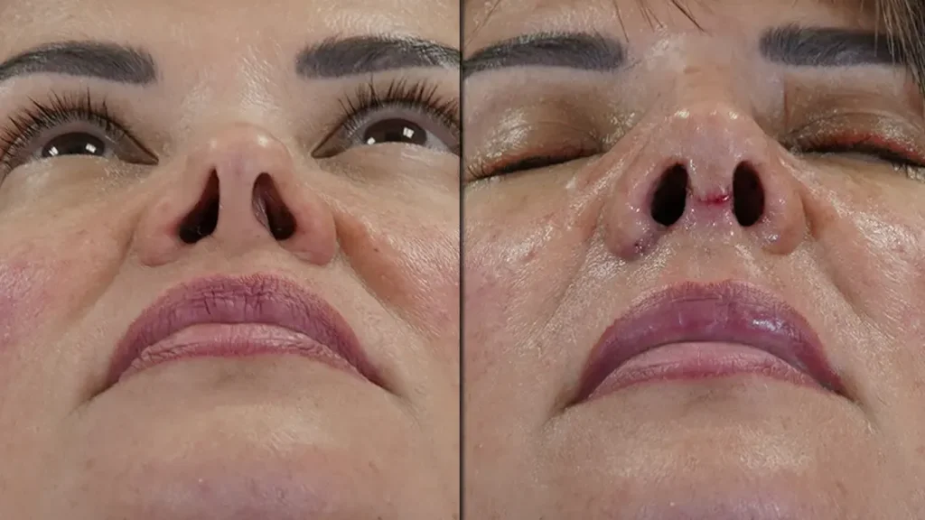 The Minimum Donor Tissue Approach in Revision Rhinoplasty: Is Rib Cartilage Always Necessary?