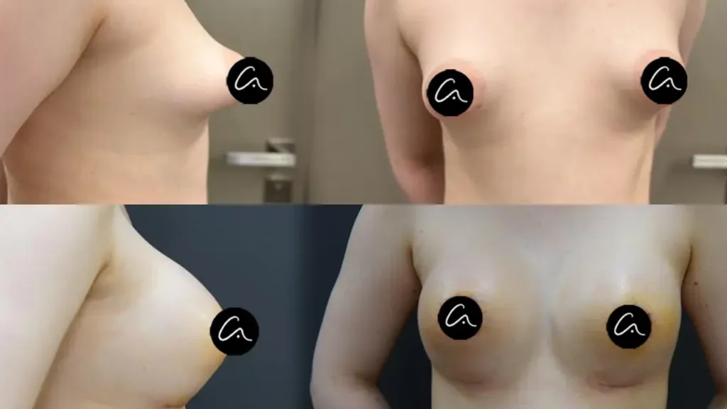 tuberous breasts