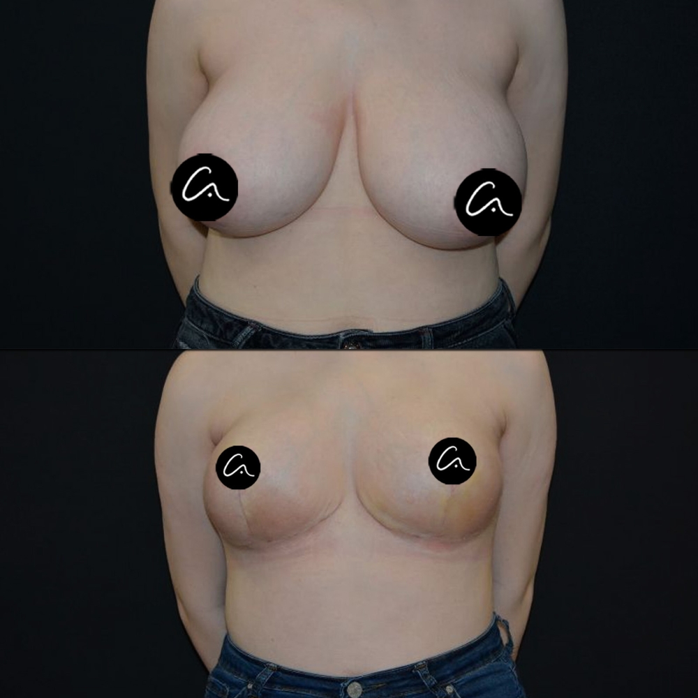 What Should Be the Ideal Forehead Width Measurements for Women and Men?