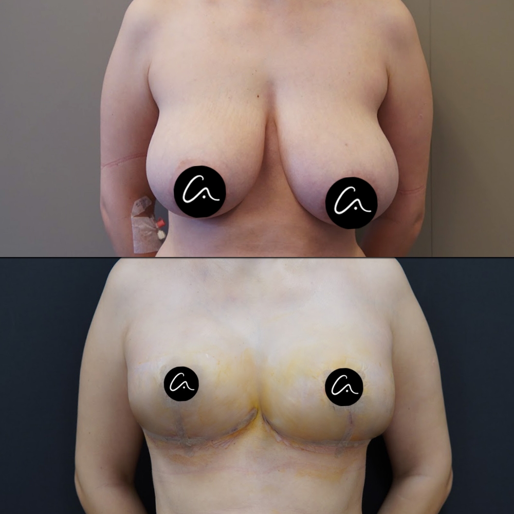 What Should Be the Ideal Forehead Width Measurements for Women and Men?