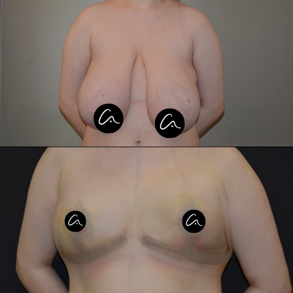 What Should Be the Ideal Forehead Width Measurements for Women and Men?