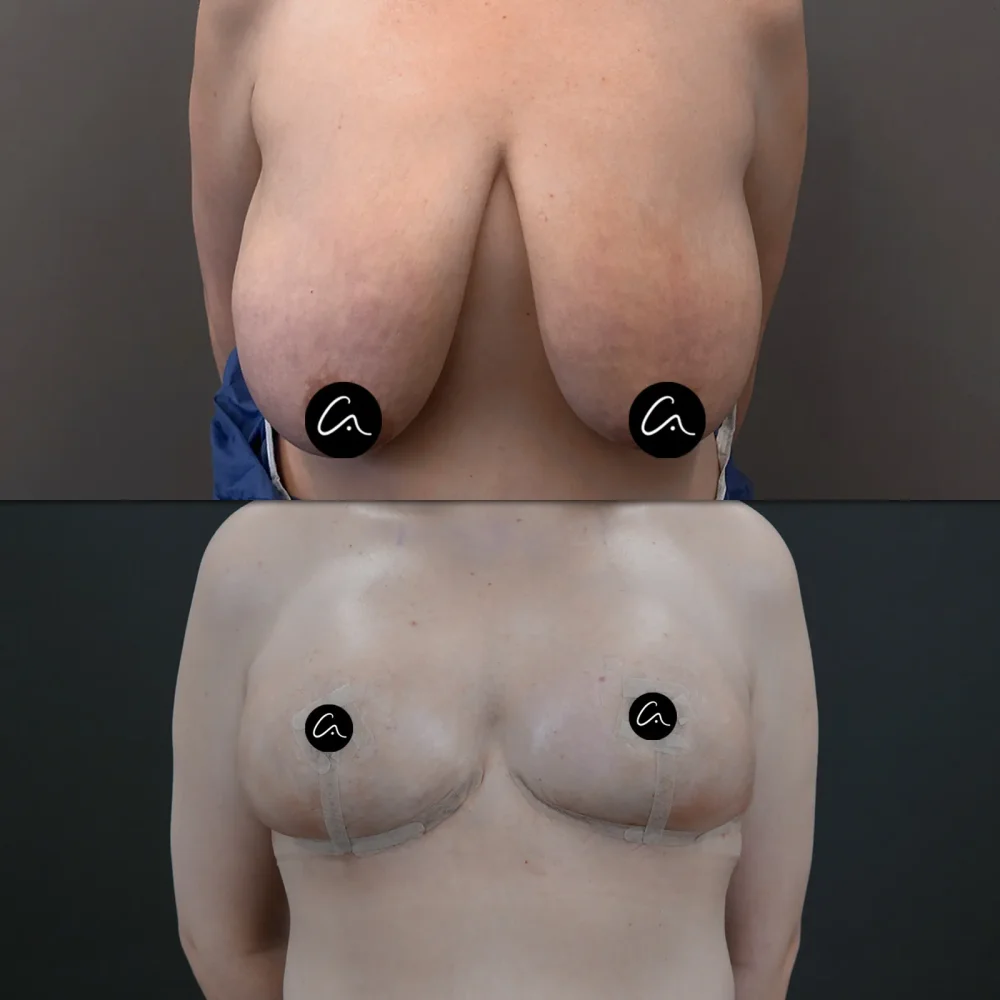 What Should Be the Ideal Forehead Width Measurements for Women and Men?